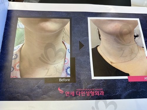 韩国延世多仁整形外科颈纹手术实例2