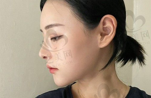 韩国优雅人整形外科自体肋骨鼻怎么样?内含院长介绍/口碑评价/真人案例分享