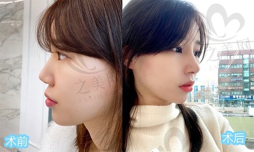 韩国优雅人肋骨鼻修复