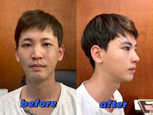 优雅人整形外科肋骨鼻手术实例3