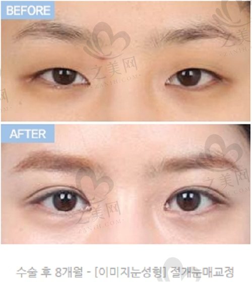 韩国DA整形外科眼整形手术实例