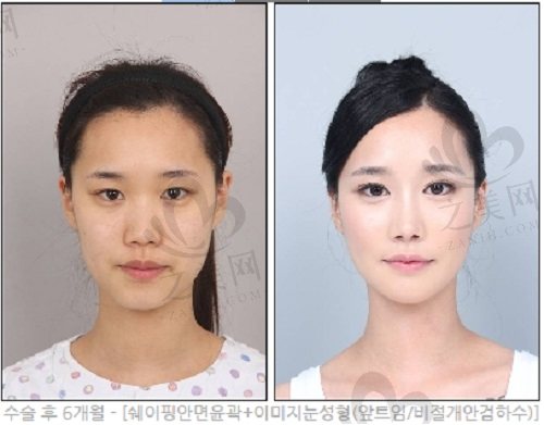 韩国DA整形外科轮廓整形手术实例