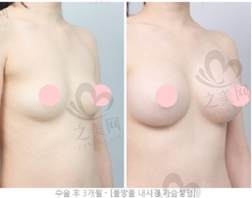 韩国DA整形外科隆胸手术实例