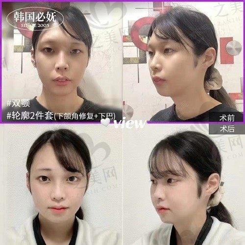 韩国必妩整形医院双鄂手术水平如何?排名前三/口碑好/技术靠谱