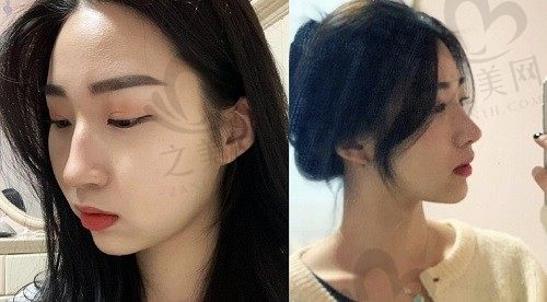 韩国优雅人鼻修复整形怎么样?朴哲佑高难度鼻修复口碑技术好