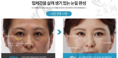 韩国大眼睛医院下眼睑提升术怎么样?眼底脂肪变废为宝/泪沟眼袋同步解决