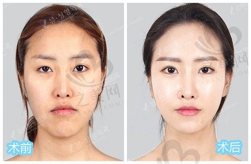 韩国必妩整形医院双鄂手术怎么样?口碑好/名气大/技术更新快做过的都说好