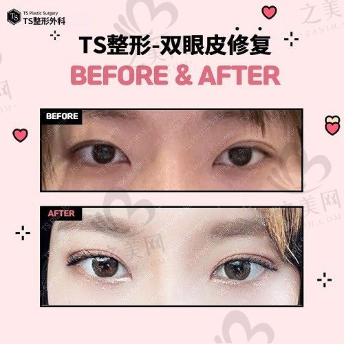 韩国TS整形外科双眼皮修复怎么样?细节把控到位且风格自然清新