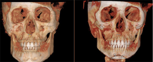 吴铭埈轮廓下颌角CT