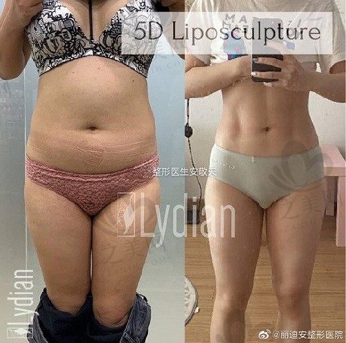 韩国丽迪安医院吸脂怎么样?安敬天5D脂肪雕刻术颇受好评