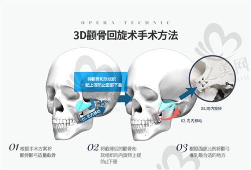 韩国欧佩拉颧骨回旋手术方法