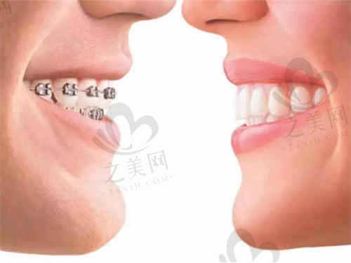 呼和浩特华医口腔医院牙齿矫正有哪些方式