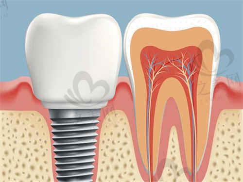 深圳壹方口腔种植牙项目价格