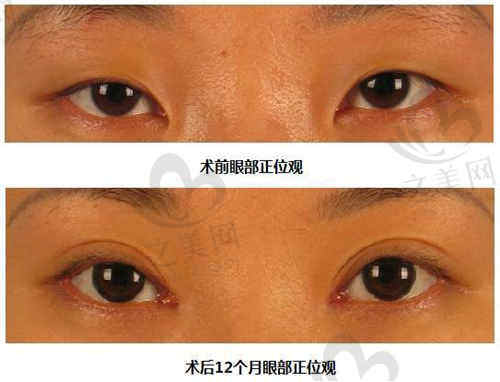 北京丽合医疗美容医院薛轶群医生双眼皮手术