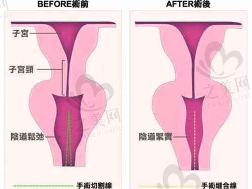 北京丽合医疗美容医院刘冰医生3D生物束带阴道紧致术