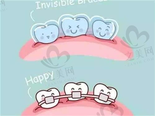 上海清木口腔隐适美牙套价格才5888元起,无套牙套更便宜!
