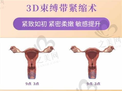北京丽合医疗美容医院刘冰医生3D生物束带阴道紧致术仅需29800元起!