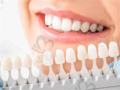 上海清木口腔牙贴面价格低至1200元,让你笑起来自信!
