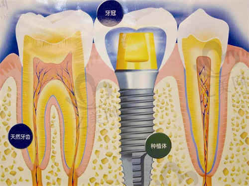 上海清木口腔种牙手术怎么样