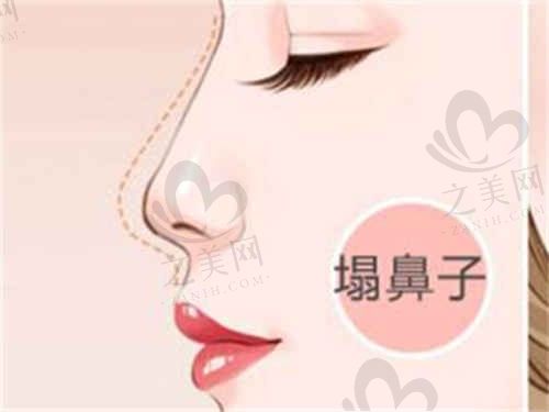 周柯医生隆鼻手术多少费用?重庆新铜雀台整形美容医院膨体硅胶隆鼻7969元起!