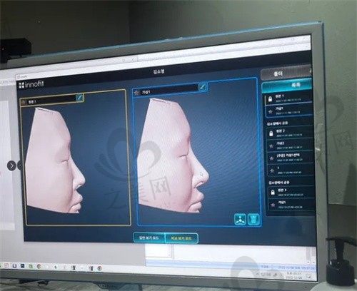 韩国GNG鼻部整形攻略:医院级别认证+3D定制鼻骨+价格公开透明