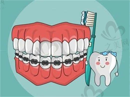 上海科瓦口腔正畸仅需9800元起!自锁托槽矫正优缺点对比