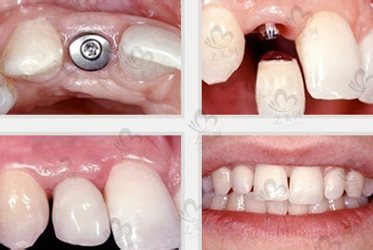 深圳瑞尔齿科种植牙贵不贵?韩国奥齿泰8000元左右一颗