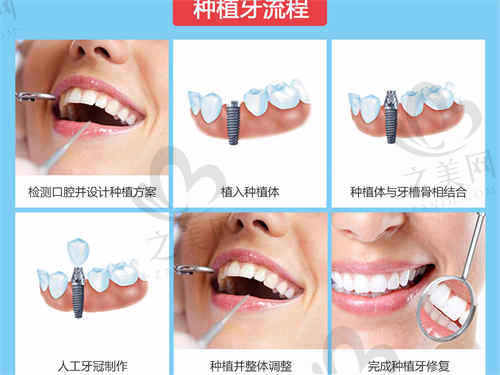 杭州牙医森口腔种植牙
