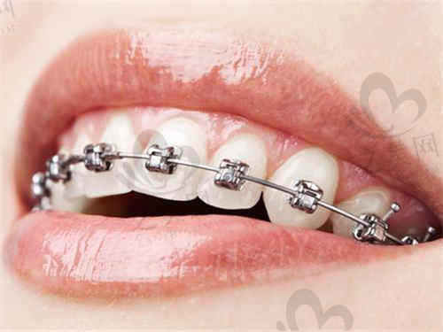 杭州牙医森口腔牙套质量可信吗