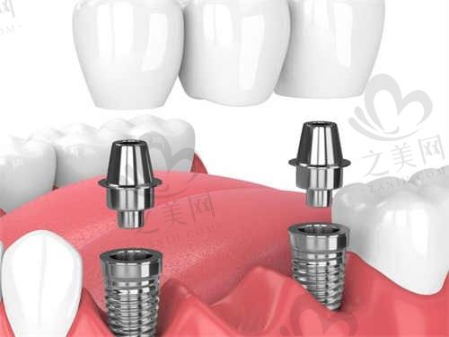  西安天皓口腔种植牙价格表曝光！国产种植体仅4200元！