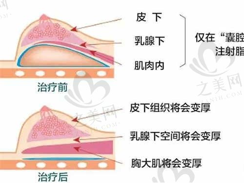 上海爱丽姿医疗美容医院胸部整形好不好?告诉你自体脂肪填充成果自然、风险较低
