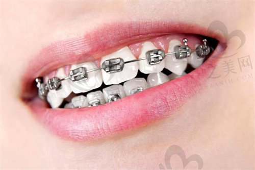 如何选择适合自己的牙齿矫正方法