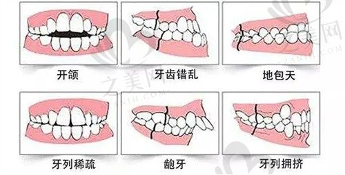 安徽池州康诺矫正治疗要花费多少?埃蒙迪金属托槽矫正4500-14500元