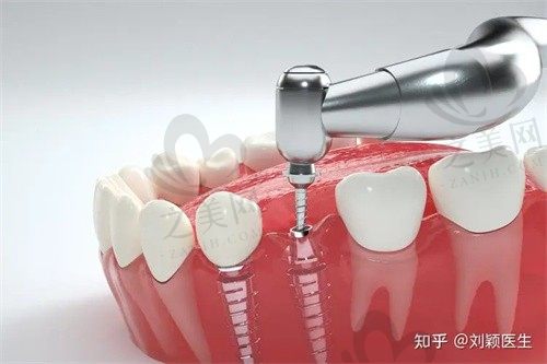 想种牙又想省钱?这家南京口腔医院口腔种植只要3780元起!