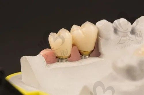 深圳种牙价格贵吗?爱康健口腔口碑好,牙医技术精湛经验丰富