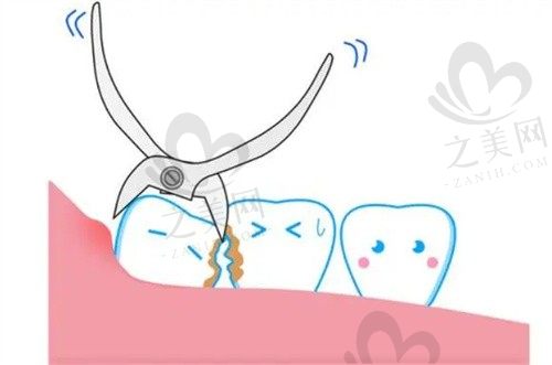 来衡阳欧亚协合口腔医院拔牙需要什么准备?分享拔牙小贴士