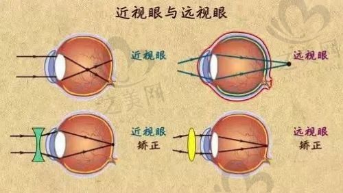 北京熙仁眼科医院ICL近视度数矫正3.6万起,个性化定制助你恢复视力