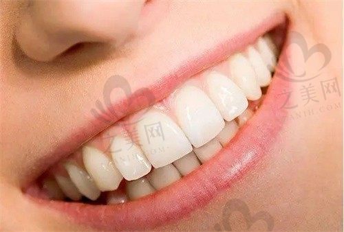 全瓷牙与烤瓷牙的区别在哪里?两种美容修复方式优缺点对比