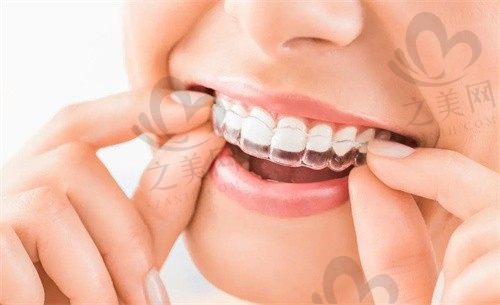 青岛优贝口腔隐形矫正价格公布,正畸费用只要16800元起