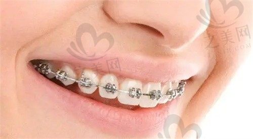 北京启康口腔朝阳区牙齿矫正,时代天使隐形矫正18000元起
