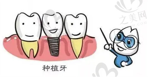 北京美呀植牙口腔种牙费用