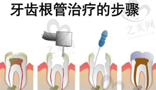 三明瑞尔口腔根管治疗多少钱一颗牙
