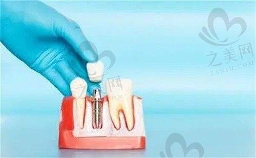 厦门瑞齿口腔口碑怎么样?数字化种植与矫正放心选择