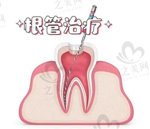 三明瑞尔口腔根管治疗多少钱一颗牙?前牙360元起后牙600元起