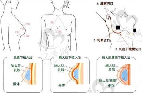 上海爱尚丽格医疗美容整形胸部隆乳项目仅需12800元起!