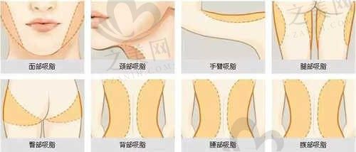泰州泰勒美口腔医院Z赵贵庆主任开眼角手术仅需3000元起