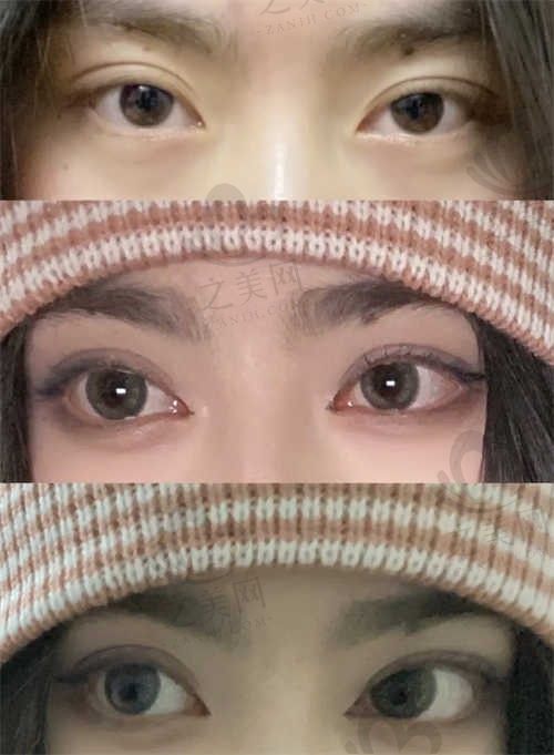 三禾医疗开外眼角手术多少钱?含医生简介及成功案例