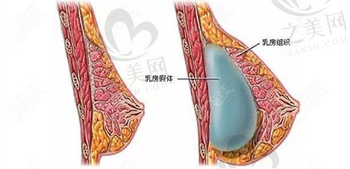 上海华美医疗胸部整形隆胸手术怎么样