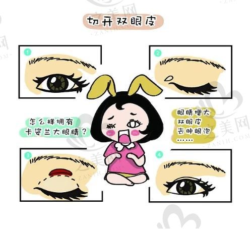 上海华美医疗切开双眼皮怎么样?术后恢复快放心推荐