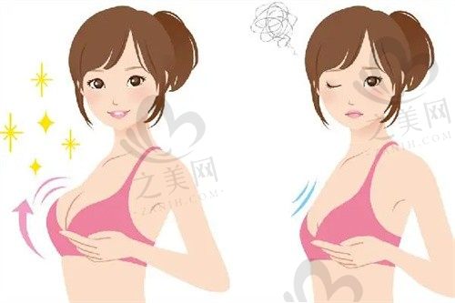 上海华美医疗胸部整形隆胸手术怎么样?真实案例分享经验!